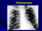 Диференциальная диагностика шаровидных образований лёгких Слайд: 25