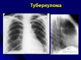 Диференциальная диагностика шаровидных образований лёгких Слайд: 27