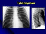Диференциальная диагностика шаровидных образований лёгких Слайд: 28