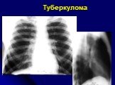 Диференциальная диагностика шаровидных образований лёгких Слайд: 29