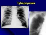 Диференциальная диагностика шаровидных образований лёгких Слайд: 30
