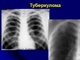 Диференциальная диагностика шаровидных образований лёгких Слайд: 31