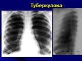 Диференциальная диагностика шаровидных образований лёгких Слайд: 32