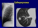 Диференциальная диагностика шаровидных образований лёгких Слайд: 33