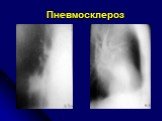 Диференциальная диагностика шаровидных образований лёгких Слайд: 52