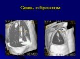 Диференциальная диагностика шаровидных образований лёгких Слайд: 86