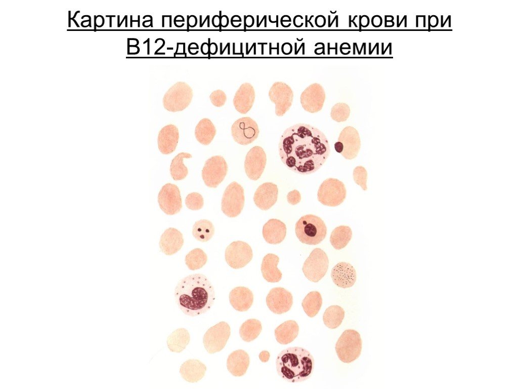 Заболевание б 12. Кровь при b12 дефицитной анемии. Б12 дефицитная анемия картина крови. Картина крови при b12 дефицитной анемии. Витамин б12 дефицитная анемия.