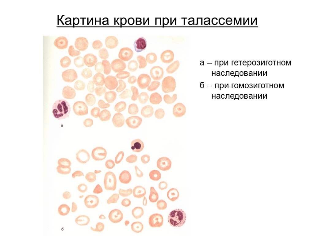 Mch анемия. Талассемия картина крови. Талассемия картина крови периферической. Картина периферической крови при талассемии.