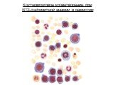 Костномозговое кроветворение при В12-дефицитной анемии в ремиссии