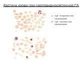 Картина крови при серповидноклеточной ГА. а – при гетерозиготном наследовании б – при гомозиготном наследовании