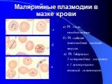 Малярийные плазмодии в мазке крови. а) Pl. vivax стадия кольца б) Pl. malariae лентовидный шизонт морула в) Pl. falciparum 3 кольцевидных шизонта в 1 эритроците женский гаметоцит. а б в