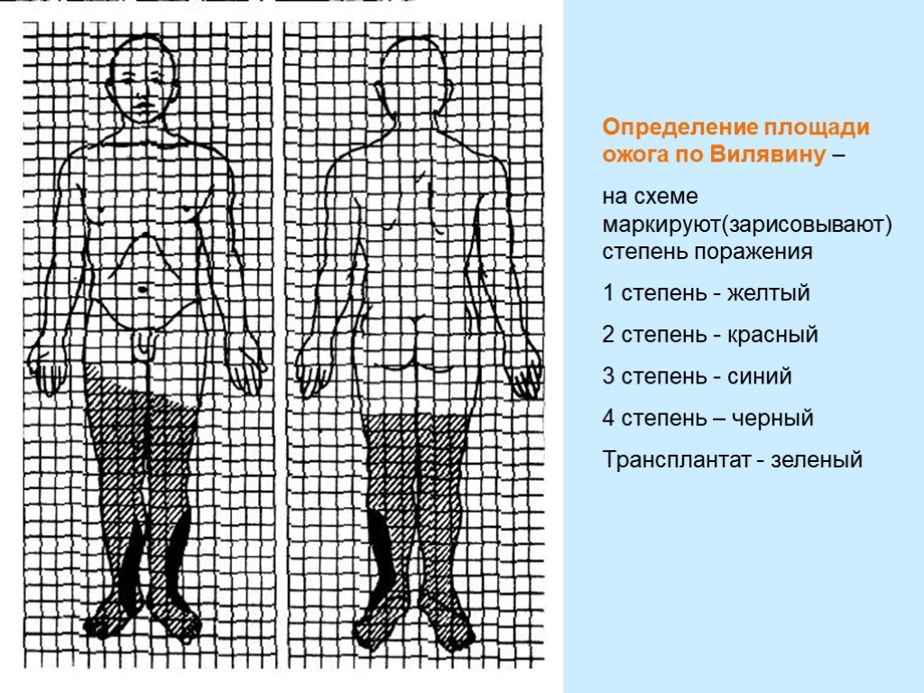 Определение площади. Скиццы Вилявина. Метод Вилявина. Площадь ожога схема Вилявина. Таблица измерения площади ожогов.