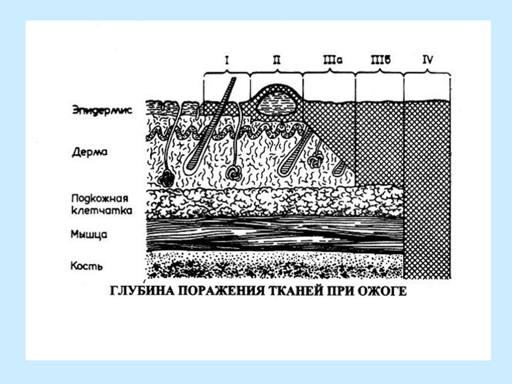 Глубина определенный. Схема ожогов по глубине поражения. Глубина поражения при ожогах. Классификация ожогов по глубине поражения. Определение глубины ожога.