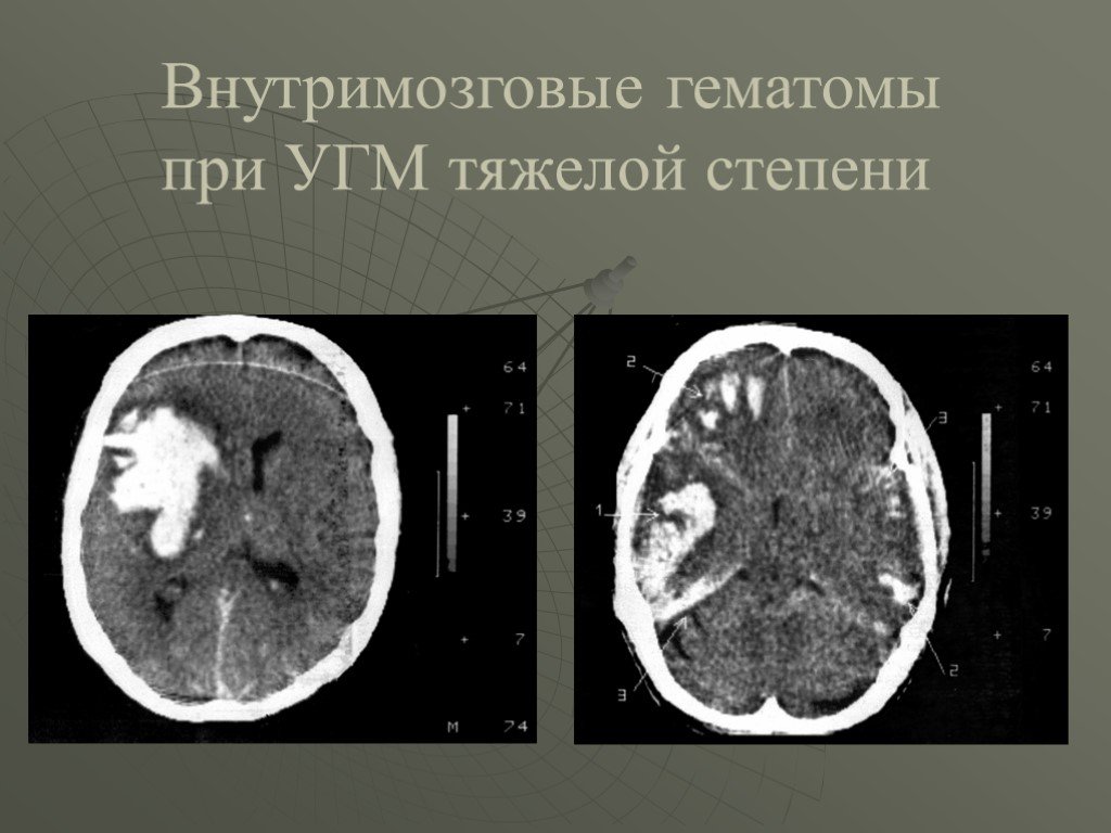 Гематома черепно мозговой травме. Внутримозговая гематома мрт. Внутримозговая гематома кт. Ушиб головного мозга тяжелой степени кт. Кт внутримозговая гематома головного мозга.