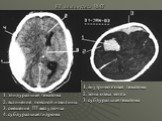 КТ диагностика ЧМТ. 1. эпидуральная гематома 2. вклинение поясной извилины 3. смещение III желудочка 4. субдуральная гидрома. 1. внутримозговая гематома 2. зона отека мозга 3. субдуральная гематома