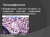 Патоморфология. Верификация диагноза основана на выявлении гранулем, содержащих гистиоциты (клетки Лангерганса). Острый диссеминированный гистиоцитоз из клеток Лангерганса