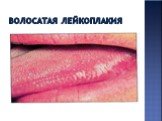 Клинические проявления поражения слизистой оболочки полости рта при ВИЧ-инфекции Слайд: 21