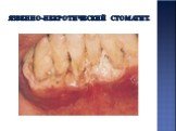 Клинические проявления поражения слизистой оболочки полости рта при ВИЧ-инфекции Слайд: 23
