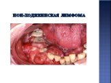 Клинические проявления поражения слизистой оболочки полости рта при ВИЧ-инфекции Слайд: 28
