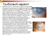 Грибковий кератит. Грибковий кератит. Викликається паразитичними грибками. Захворювання супроводжується вираженим корнеального синдромом, болем і змішаної гіперемією очі. При цьому типі кератиту виразкуються, як правило, як поверхневі, так і глибокі шари рогівки, аж до її перфорації. У запальний про