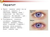 Кератит. Кератит - запалення рогівки ока, що виявляється переважно її помутнінням, виразкою, болем і почервонінням ока. Може мати травматичну або інфекційне ( грип , туберкульоз та ін) походження. Спостерігаються сльозотеча, світлобоязнь, блефароспазм, зменшення прозорості і блиску рогівки з подальш