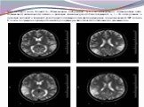 МРТ головного мозга больной А., Т2взвешенные изображения. а, б – 1е исследование: симметричные очаги повышенной интенсивности сигнала в проекции теменных долей обоих полушарий. в, г – 2е исследование: в проекции височной и теменной долей правого полушария отмечается расширение зоны измененного МР си