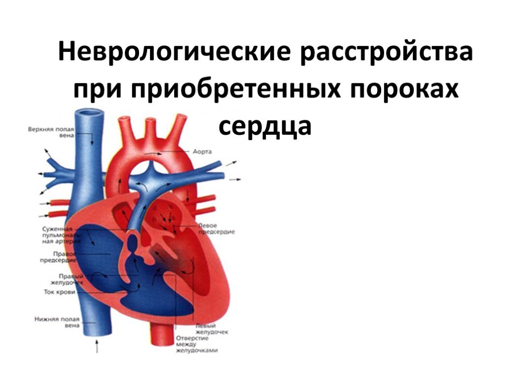 Порог сердца что это. Приобретенные пороки сердца. Приобретённыей порок сердца. Комбинированный порок сердца.