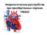 Неврологические расстройства при приобретенных пороках сердца