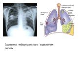 Варианты туберкулезного поражения легких
