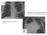 Абсцесс с уровнем жидкости слева. Обзорная рентгенограмма. Бактериальная деструкция с пиопневмотораксом справа