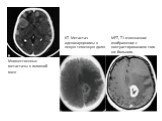 КТ. Метастаз аденокарциномы в левую теменную долю. МРТ, Т1-взвешанное изображение с контрастированием того же больного. Множественные метастазы в головной мозг