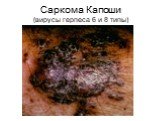 Саркома Капоши (вирусы герпеса 6 и 8 типы)