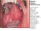 Саркома Капоши: слизистая рта. В патологический процесс часто вовлекаются регионарные лимфоузлы, реже другие органы. В процесс часто вовлекается твердое небо и прилегающие к нему десны, В представленном случае (снимок) у больного СПИДом саркома Капоши на слизистой рта сочетается с кандидозным стомат