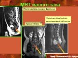 MRT малого таза Spina bifida. Ректоуретральная фистула. Липома крестцово-копчиковой области