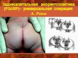 Заднесагиттальная аноректопластика (PSARP)– универсальная операция А. Pena