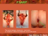 PSARP. При реконструкции мышечного комплекса не создается избытка низведенной слизистой кишки. .