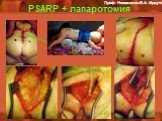 PSARP + лапаротомия