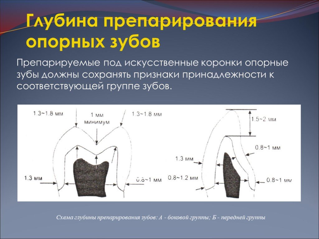 Препарирование под металлокерамическую коронку с уступом в картинках