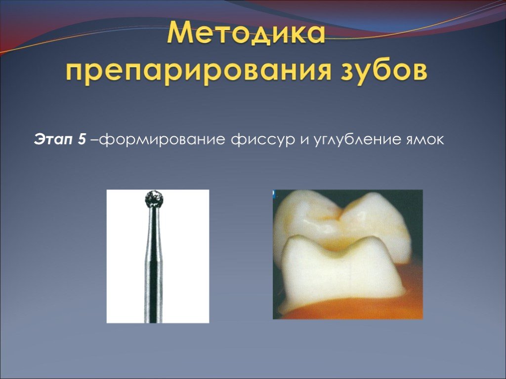 Препарирование зуба. Строение фиссур. Методики препарирования зубов. Этапы препарирования зуба. Диагностическое препарирование зуба.