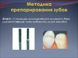 Этап 2 – С помощью цилиндрического алмазного бора удаляются твердые ткани зуба вплоть до дна желобка.