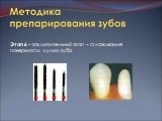 Этап 6 – заключительный этап – сглаживание поверхности культи зуба