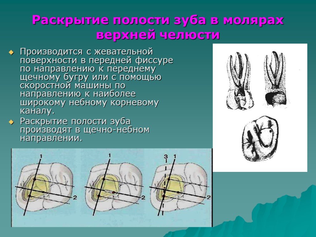 Раскрыть направление. Раскрытие полости зуба. Раскрытие полости зуба в молярах. Методика раскрытия полости зуба. Раскрытие полости зуба в молярах верхней челюсти.