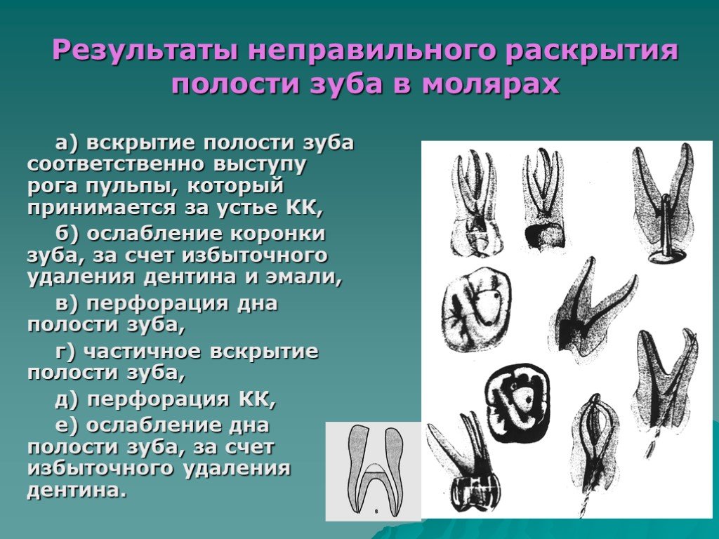 Полость зуба. Раскрытие полости зуба. Методика раскрытия полости зуба. Вскрытие полости зуба инструменты.