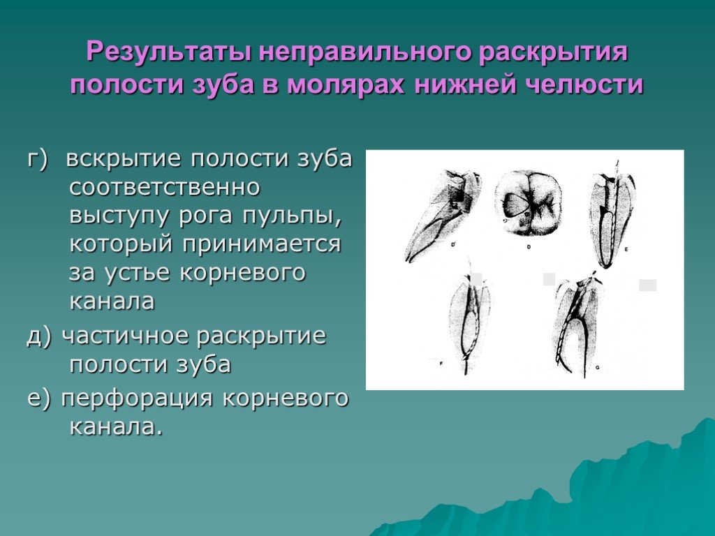 Полость зуба. Раскрытие полости зуба. Раскрытие полости зуба в молярах. Этапы раскрытия полости зуба. Вскрытие и раскрытие полости зуба.