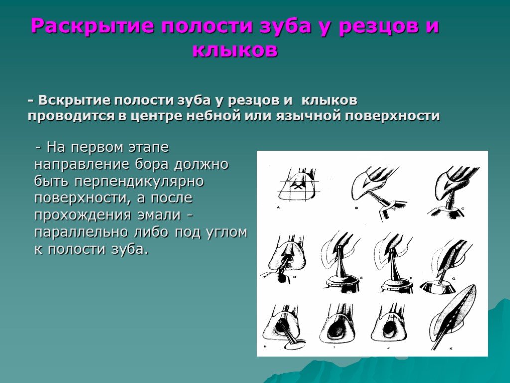 Раскрыть направление. Методика вскрытия и раскрытия полости зуба. Этапы раскрытия полости зуба. Вскрытие полости резцов.