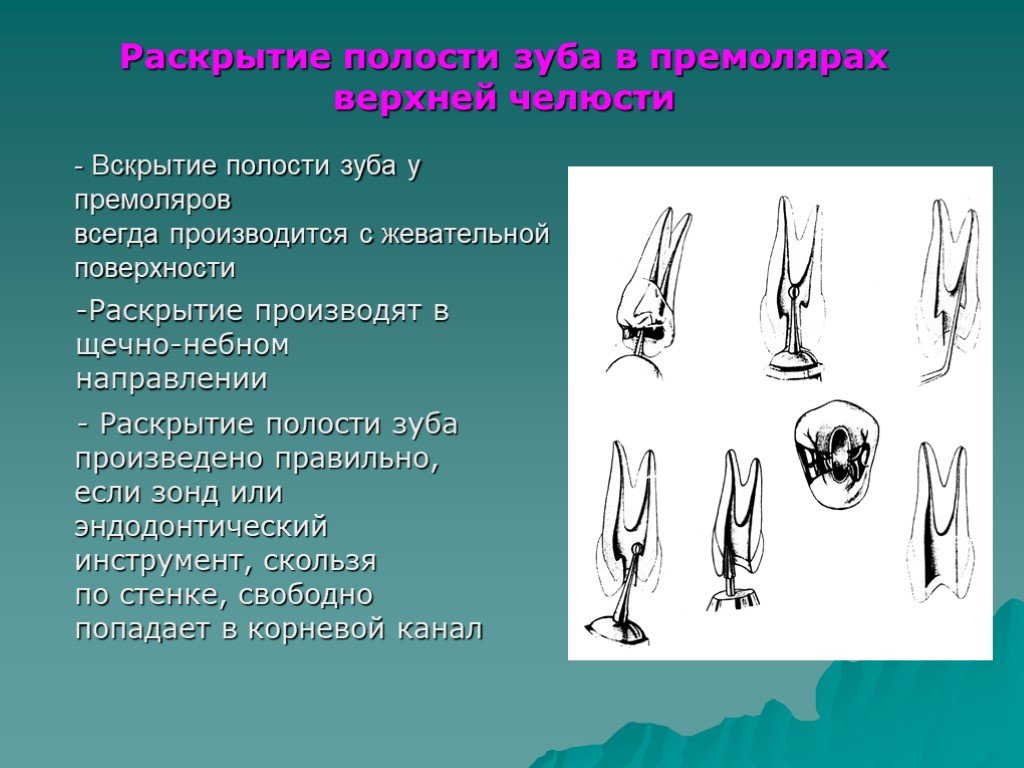 Полость зуба. Раскрытие полости зуба в премолярах верхней. Этапы вскрытия и раскрытия полости зуба. Вскрытие полости зуба инструменты. Вскрытие и раскрытие полости зуба. Инструменты.