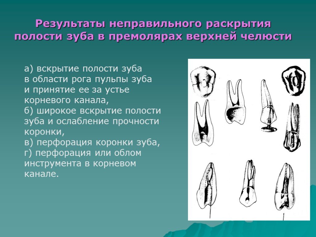 Полость соответствовать. Раскрытие полости зуба премоляров верхней челюсти. Вскрытие и раскрытие полости зуба. Этапы раскрытия полости зуба. Вскрытие полости зуба инструменты.