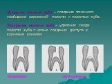 Вскрытие полости зуба – создание точечного сообщения кариозной полости с полостью зуба. Раскрытие полости зуба – удаление свода полости зуба с целью создания доступа к корневым каналам. ПРАВИЛЬНО НЕПРАВИЛЬНО