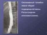 Окклюзивный тромбоз левой общей подвздошной вены. Ретроградная илиокаваграмма.