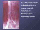 Флотирующий тромб инфраренального отдела нижней полой вены. Ретроградная илиокавограмма.